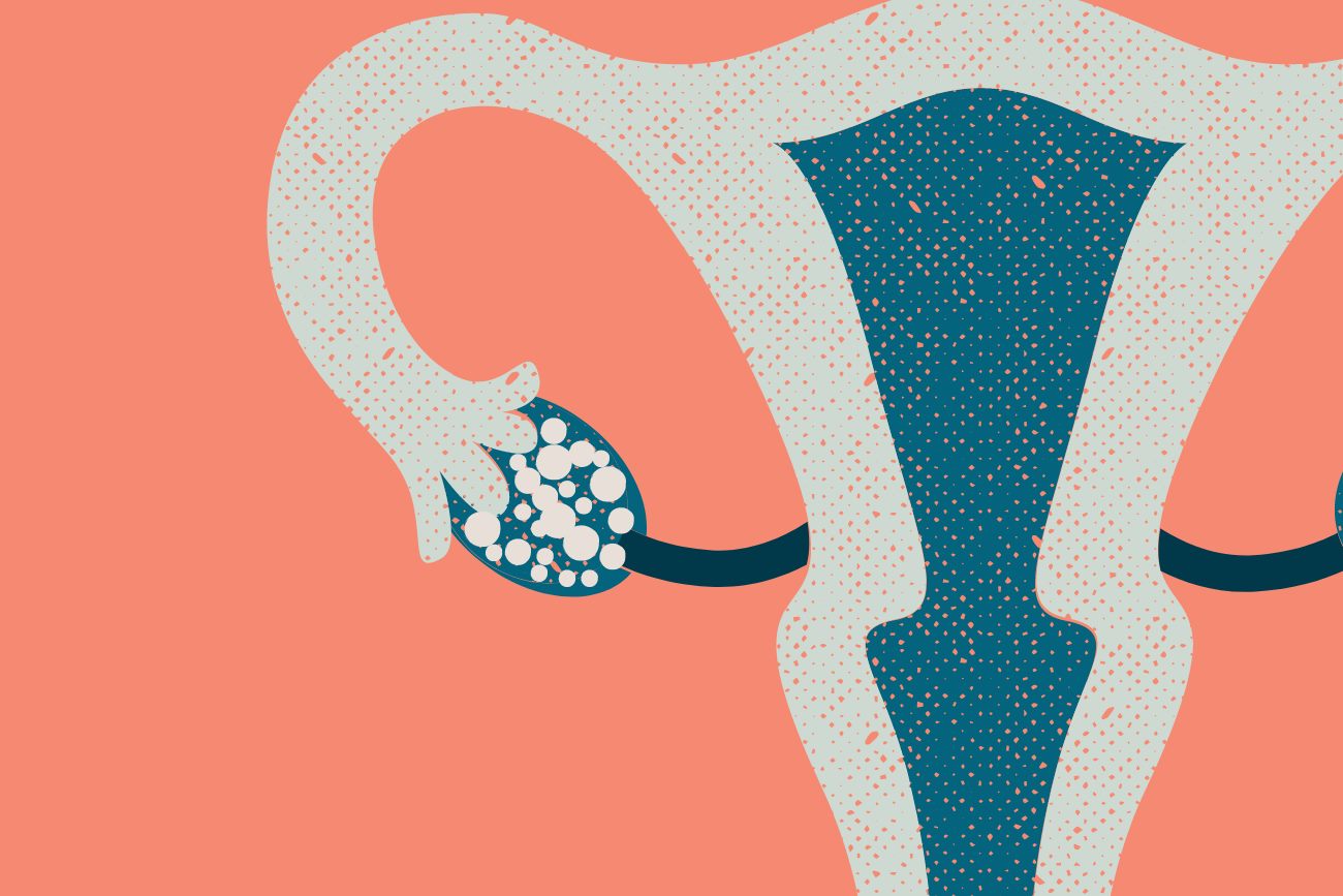 Síndrome de ovario poliquístico (SOP) y fertilidad